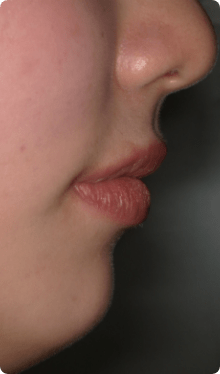 舌側矯正（裏側矯正）例6
