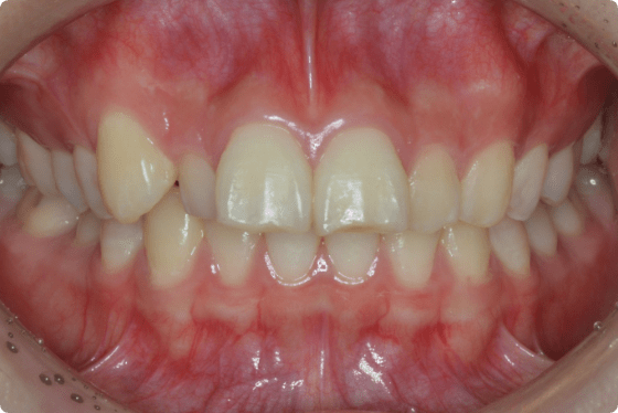 舌側矯正（裏側矯正）例3