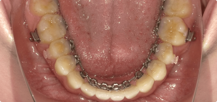 舌側矯正（裏側矯正）例1