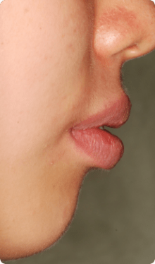 舌側矯正（裏側矯正）例5