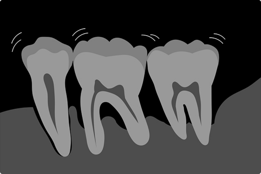 歯周病の初期症状