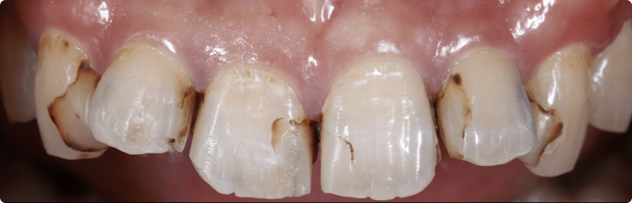 虫歯の写真