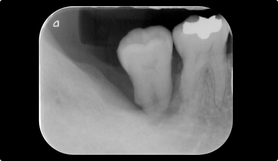 重度歯周炎と中等度歯周炎の違い