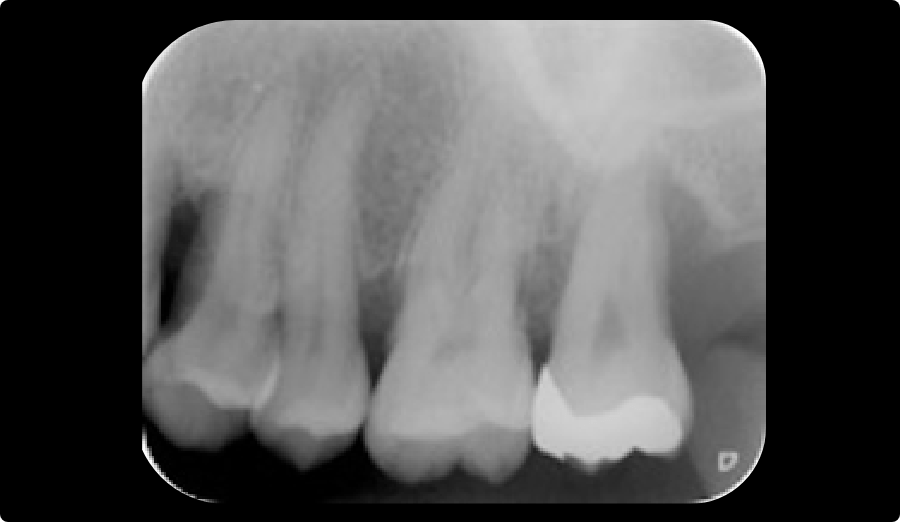 重度歯周炎と中等度歯周炎の違い