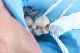 内部構造の象牙質を充填